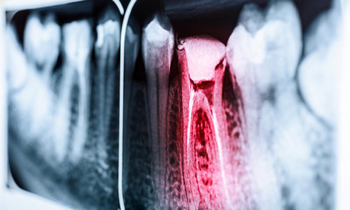 Pain Of Tooth Decay On Teeth X-Ray