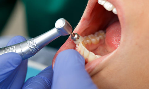 cluse up of a professional dental brushing at the clinic