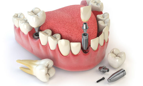 Tooth human implant. Dental concept. Human teeth or dentures. Tooth human implant. Dental concept. Human teeth or dentures. 3d illustration