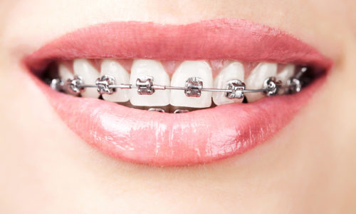 teeth with braces