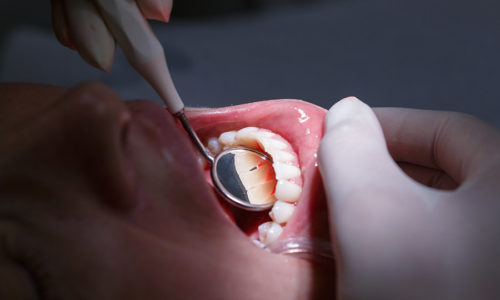 Patient at dentists office, getting her white teeth interdental spaces examined with hand-held mirror for tartar and plaque.ÊDental hygiene, painful procedures and prevention concept.